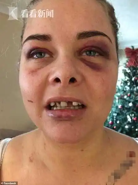  女子换脸书头像遭男友踹飞三颗牙一颗嵌入鼻腔